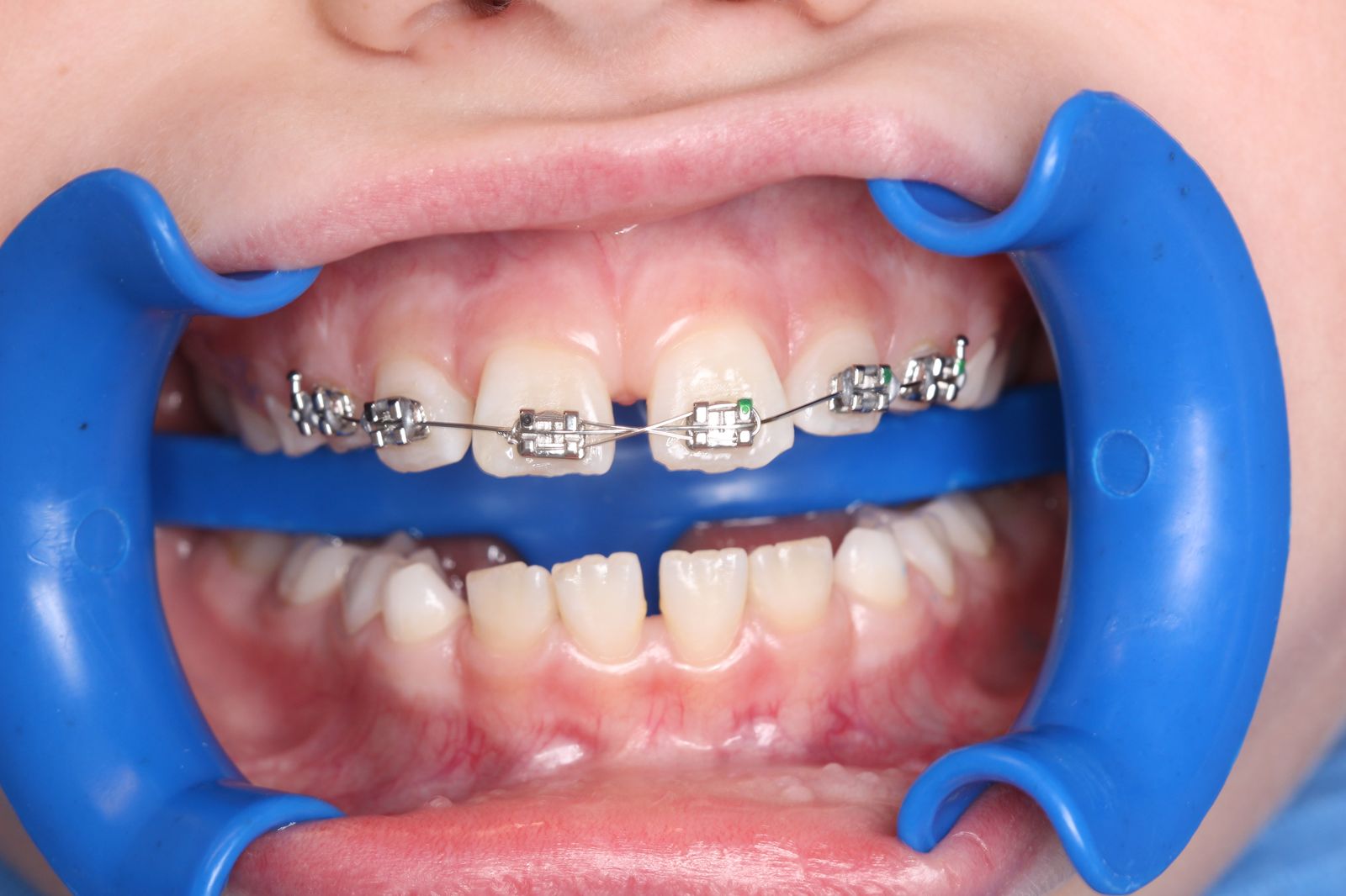 Segmentinis gydymas — po