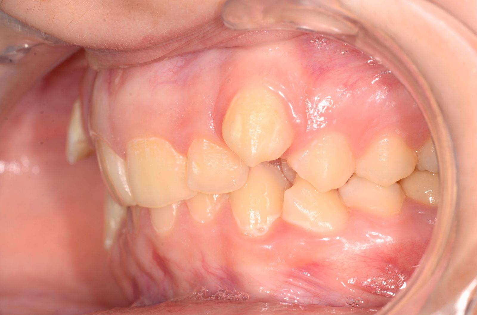 Breketai — atvejis 1