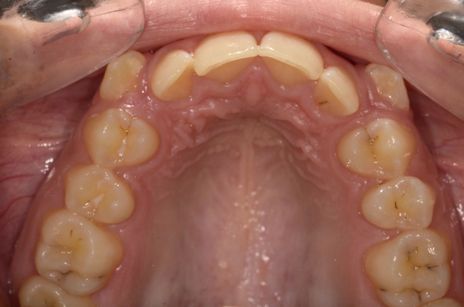 Breketai — atvejis 1