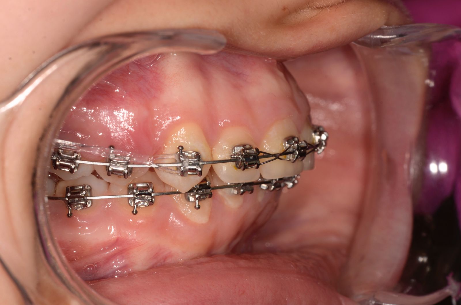 Breketai — atvejis 1