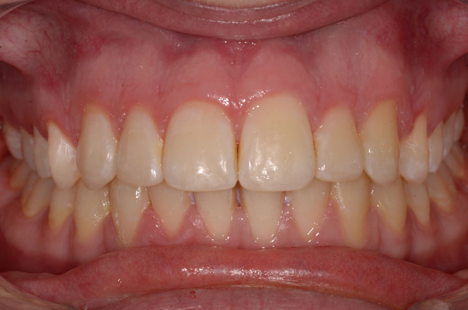 Breketai — atvejis 8