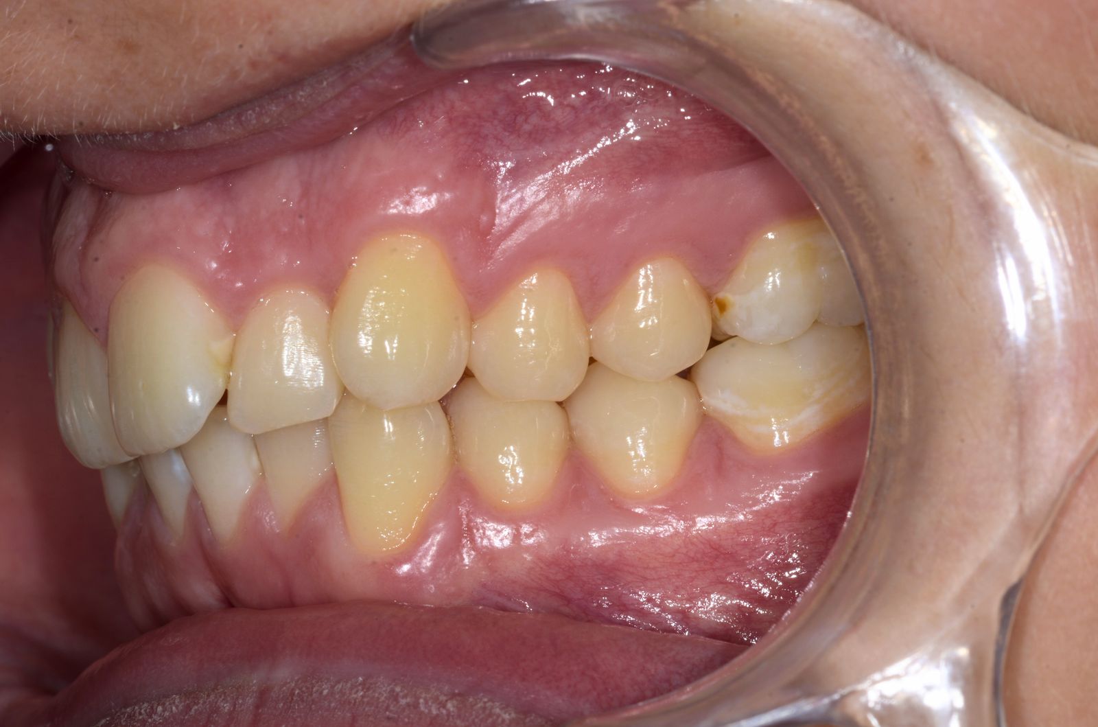 Breketai — atvejis 8