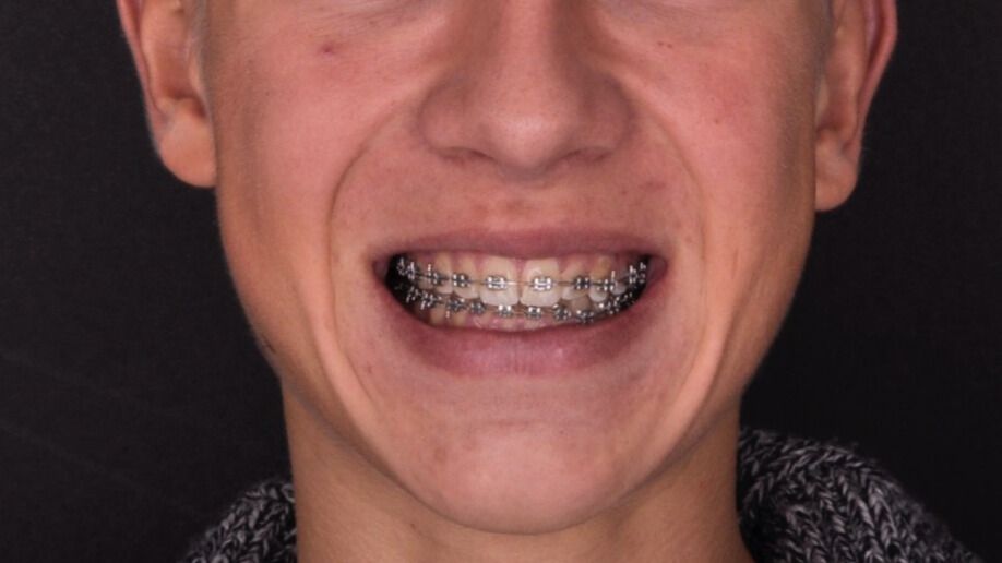 Breketai — atvejis 8