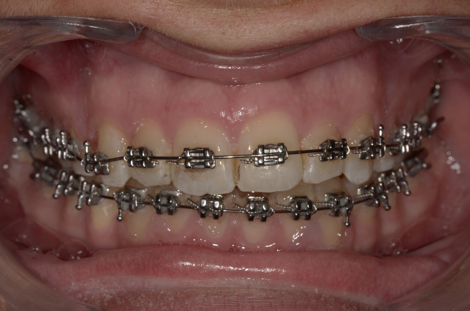 Breketai — atvejis 8