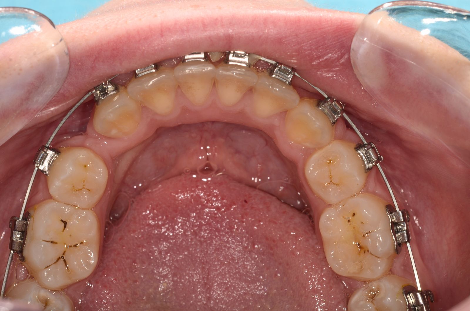 Breketai — atvejis 9