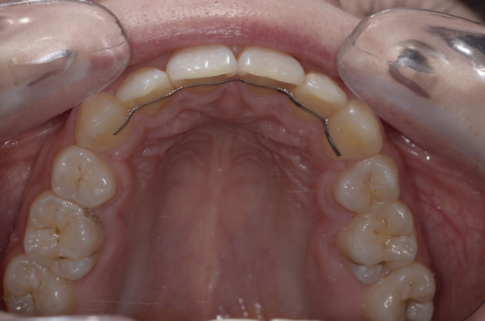 Breketai — atvejis 9