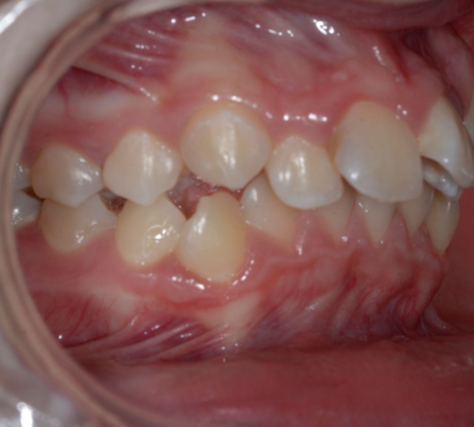 Breketai — atvejis 9