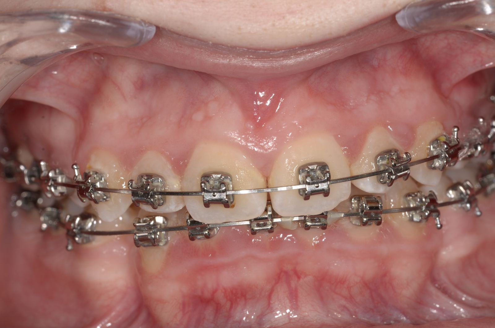 Breketai — atvejis 9