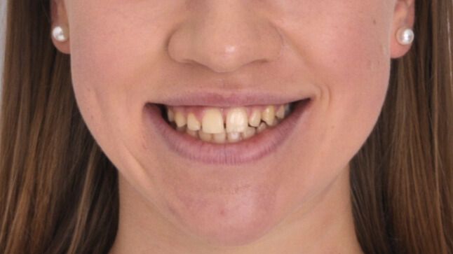 Breketai — atvejis 2