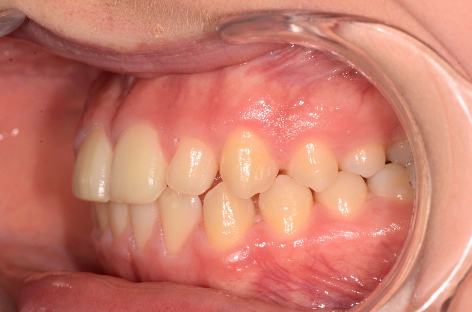 Breketai — atvejis 2