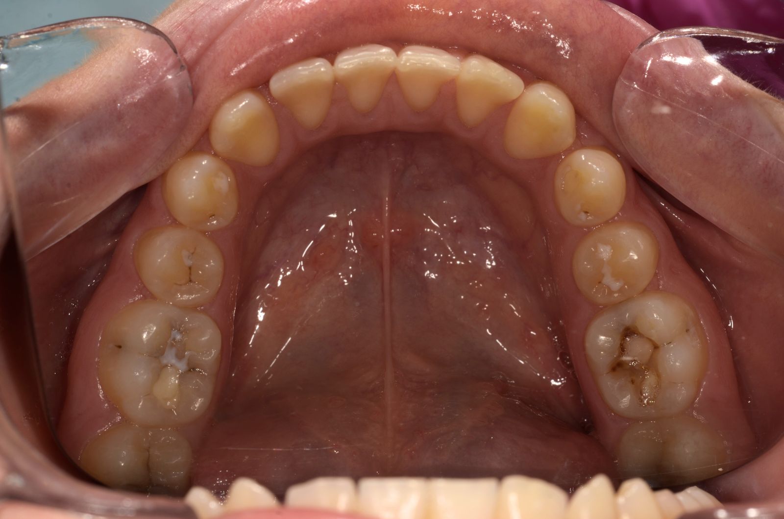 Breketai — atvejis 2