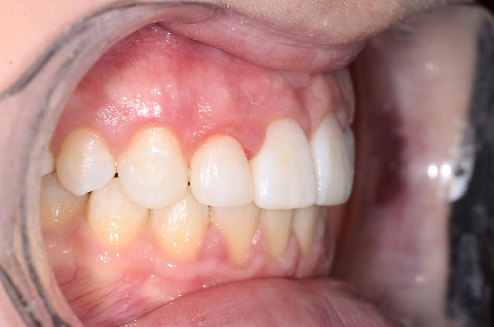 Breketai — atvejis 2