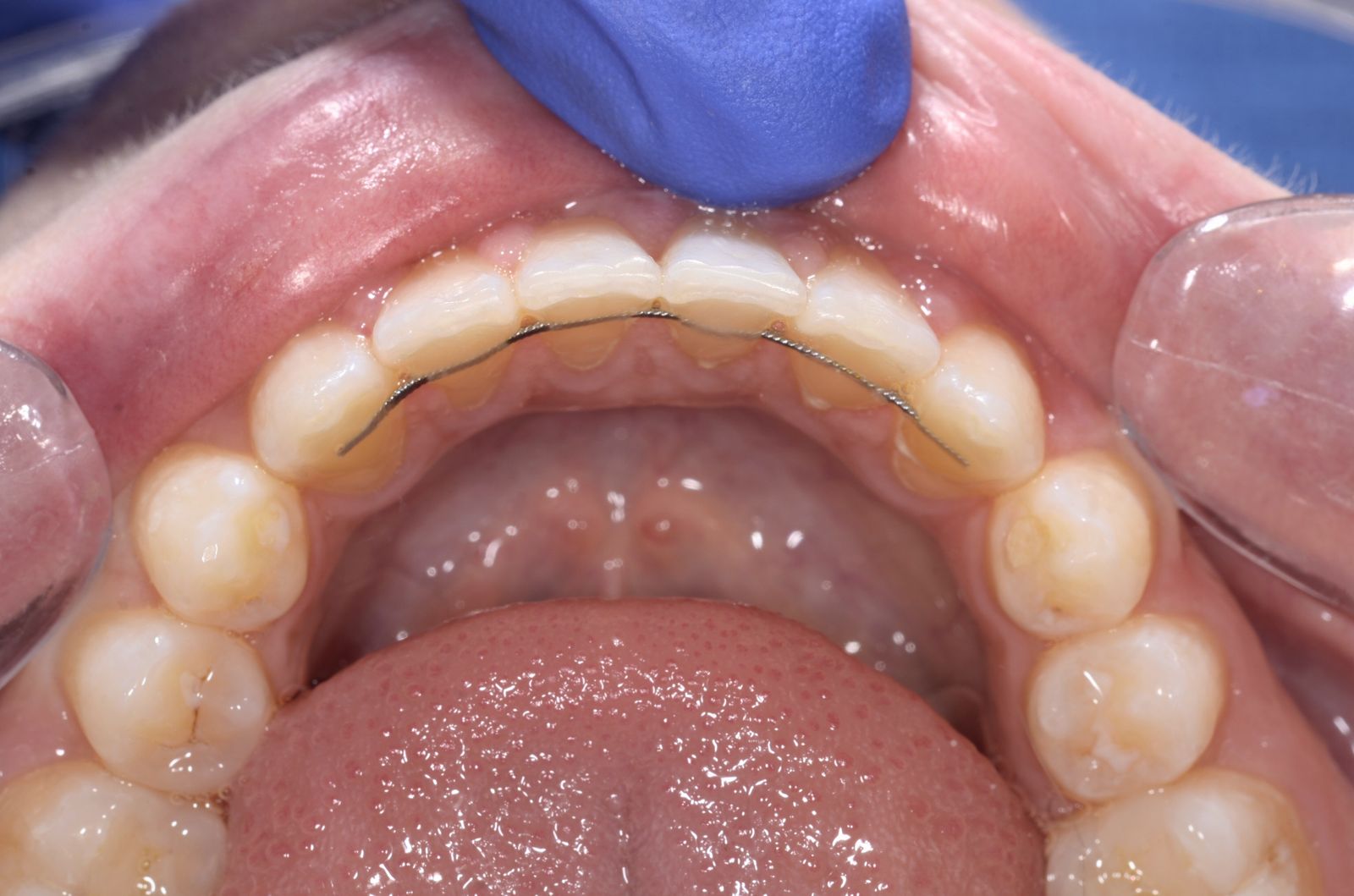 Breketai — atvejis 2