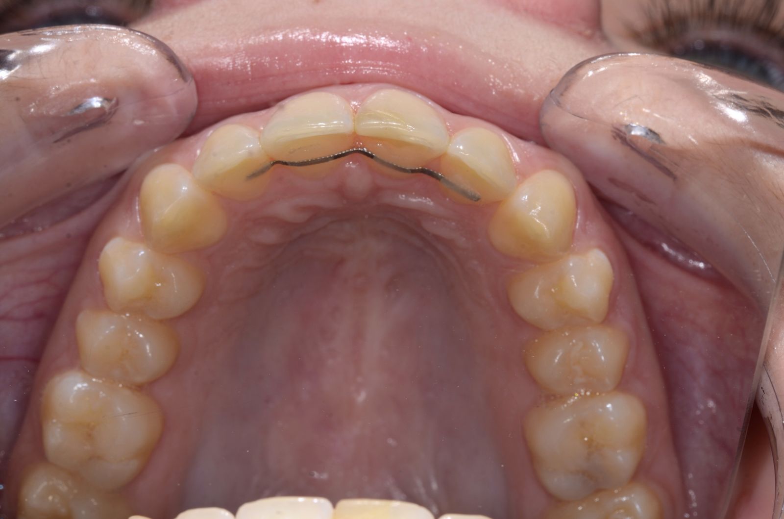 Breketai — atvejis 3