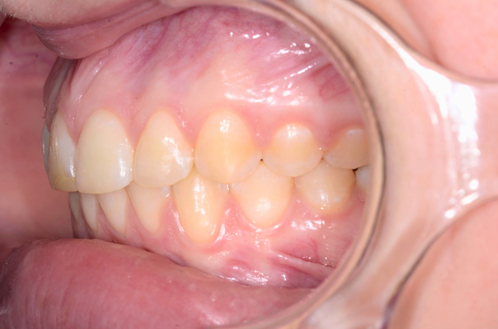 Breketai — atvejis 3