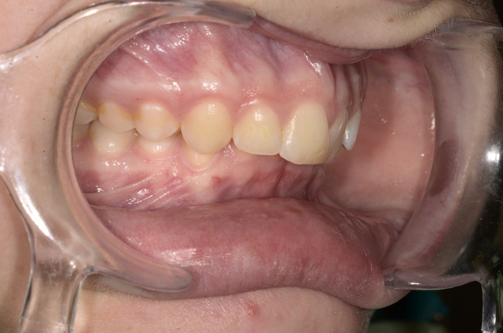 Breketai — atvejis 3