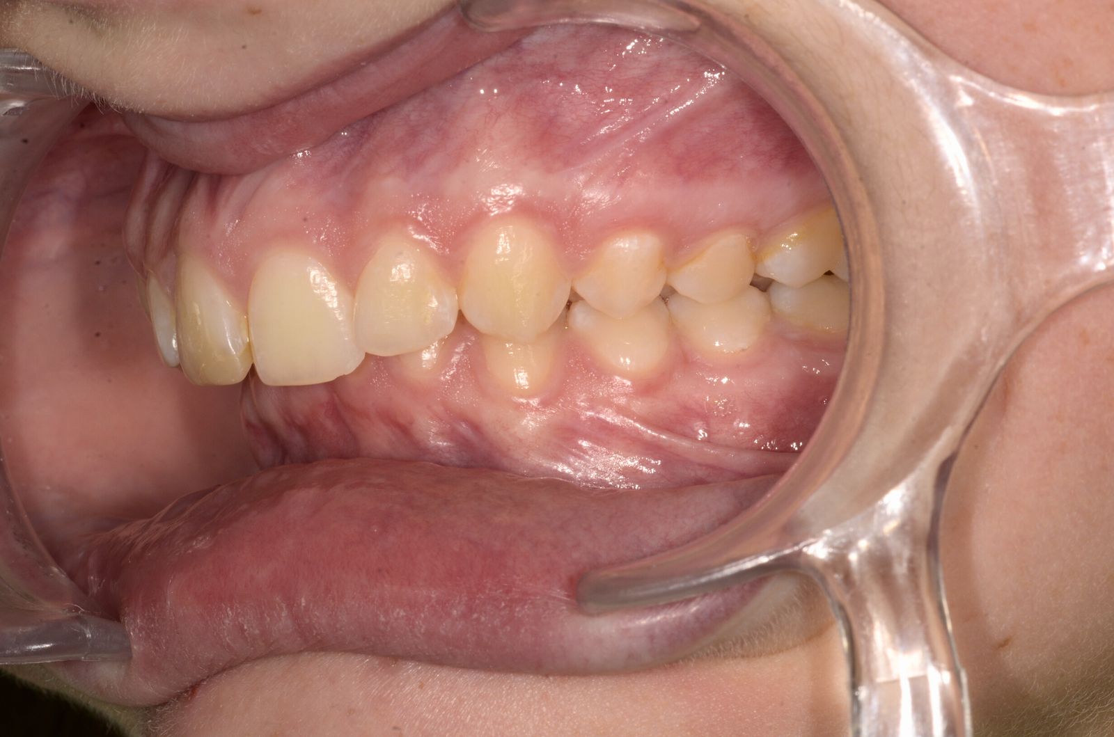 Breketai — atvejis 3