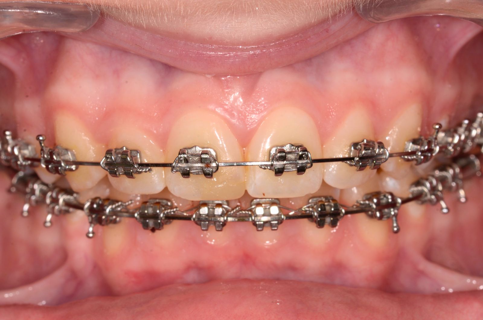 Breketai — atvejis 3