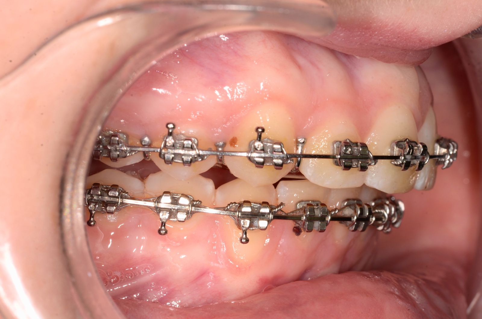 Breketai — atvejis 3