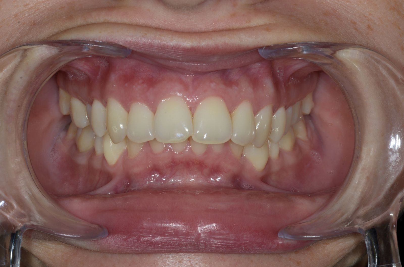 Breketai — atvejis 4