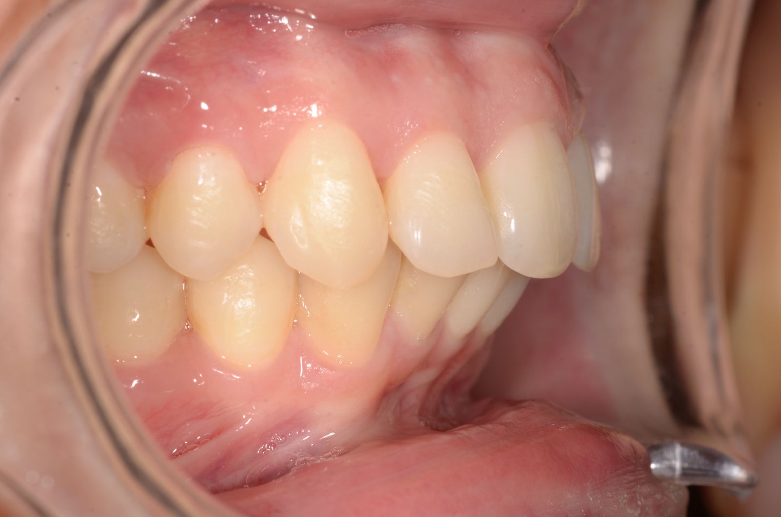 Breketai — atvejis 4