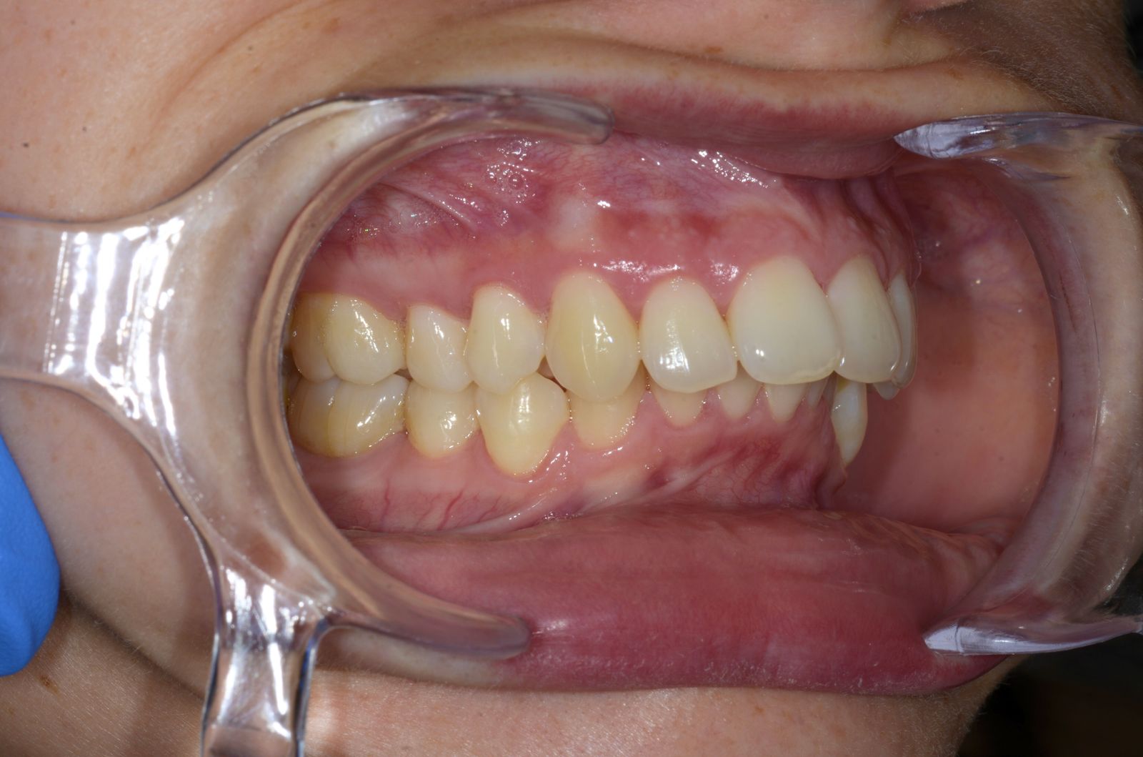 Breketai — atvejis 4