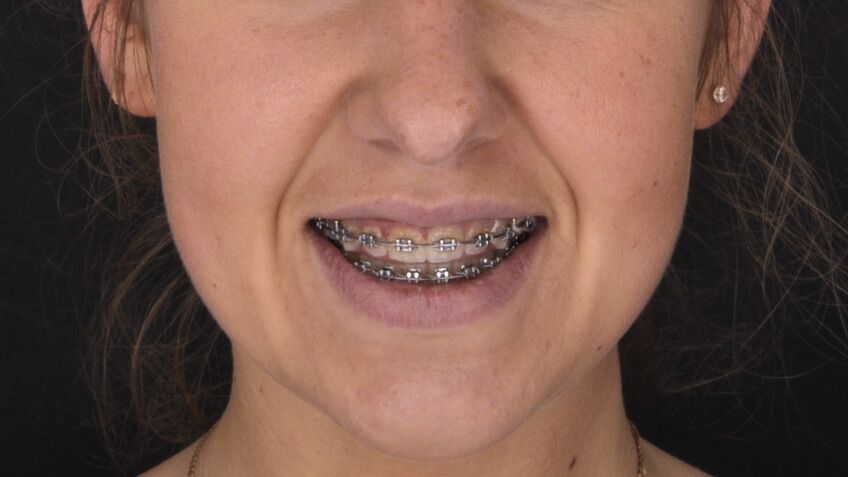 Breketai — atvejis 5