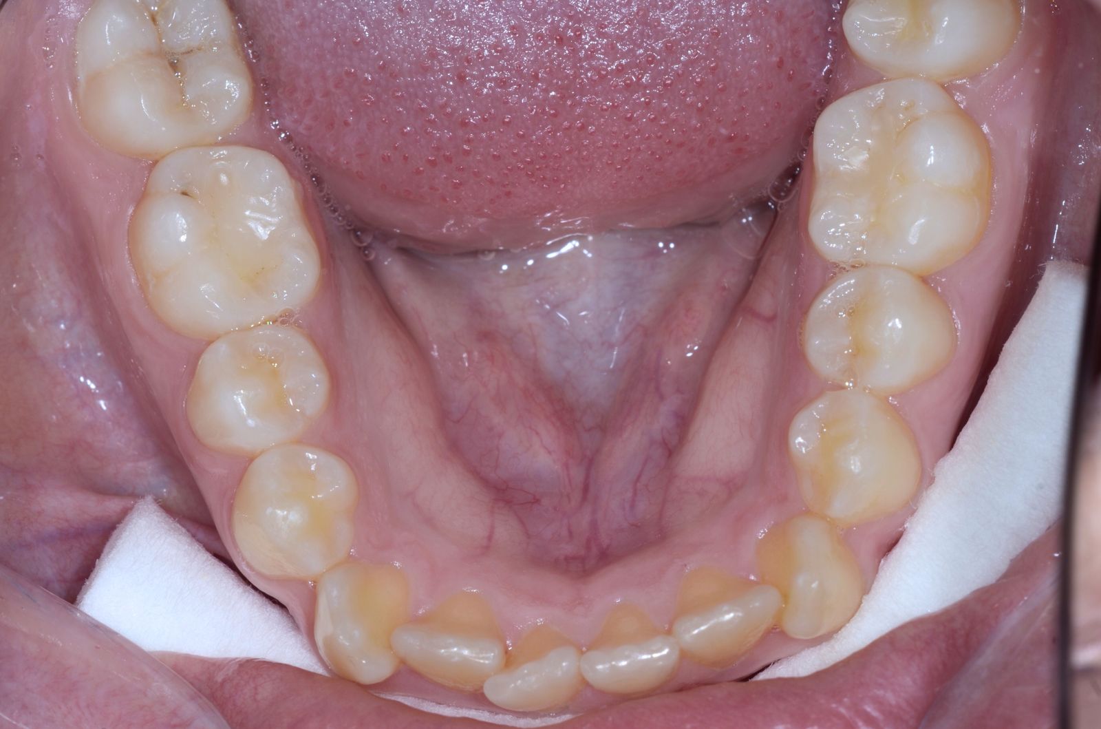 Breketai — atvejis 5