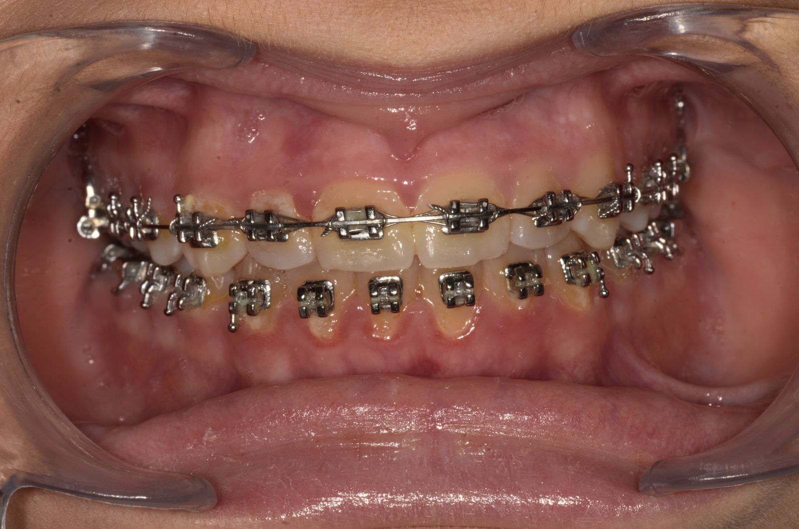 Breketai — atvejis 5