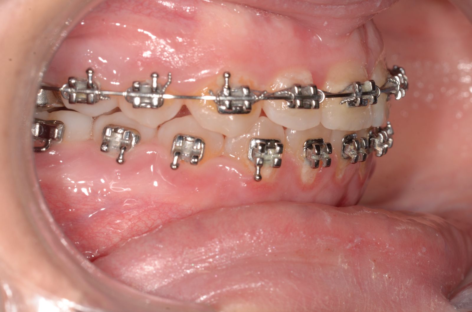 Breketai — atvejis 5