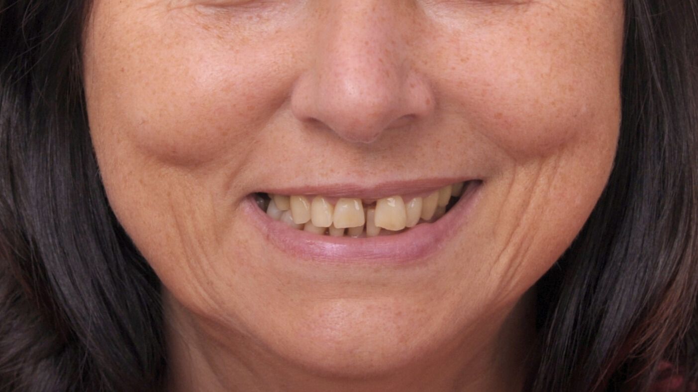 Breketai — atvejis 6