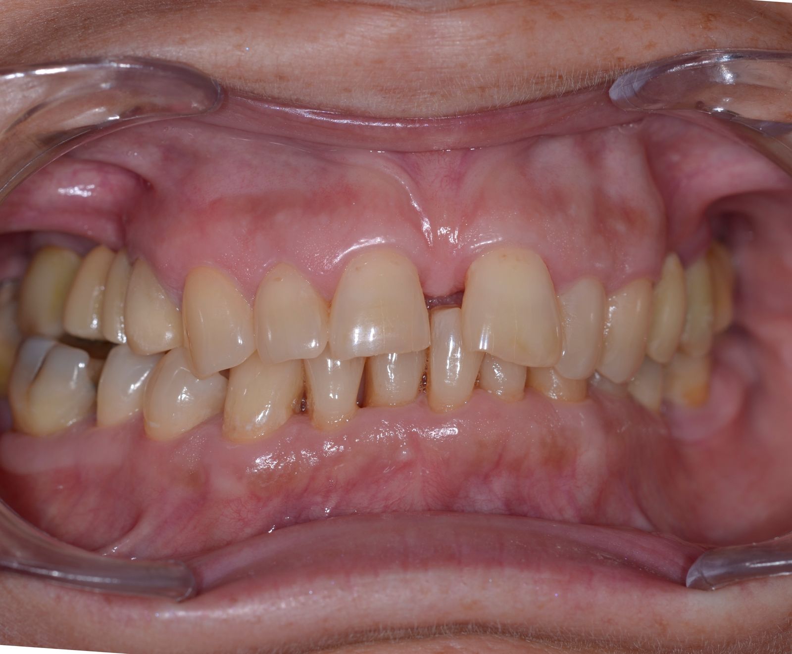 Breketai — atvejis 6