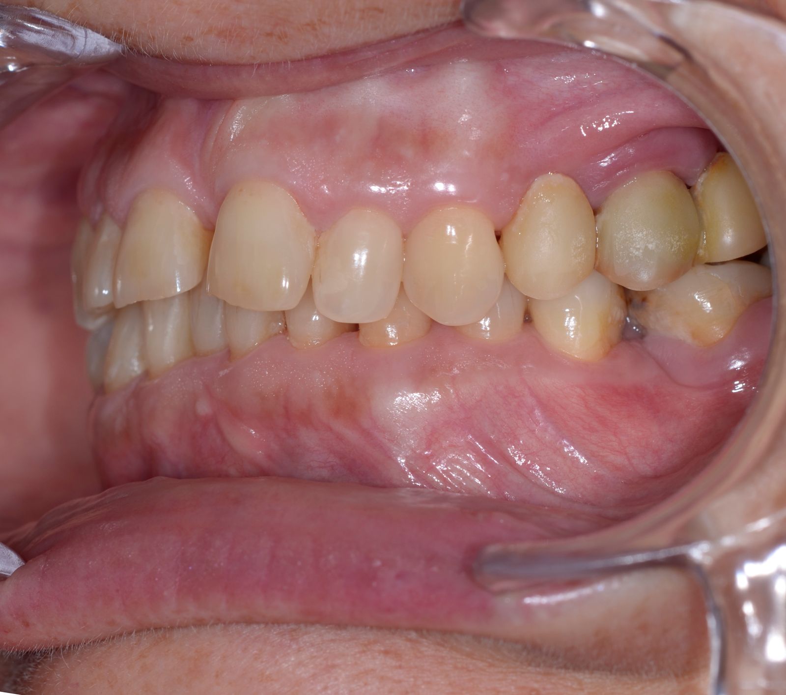 Breketai — atvejis 6