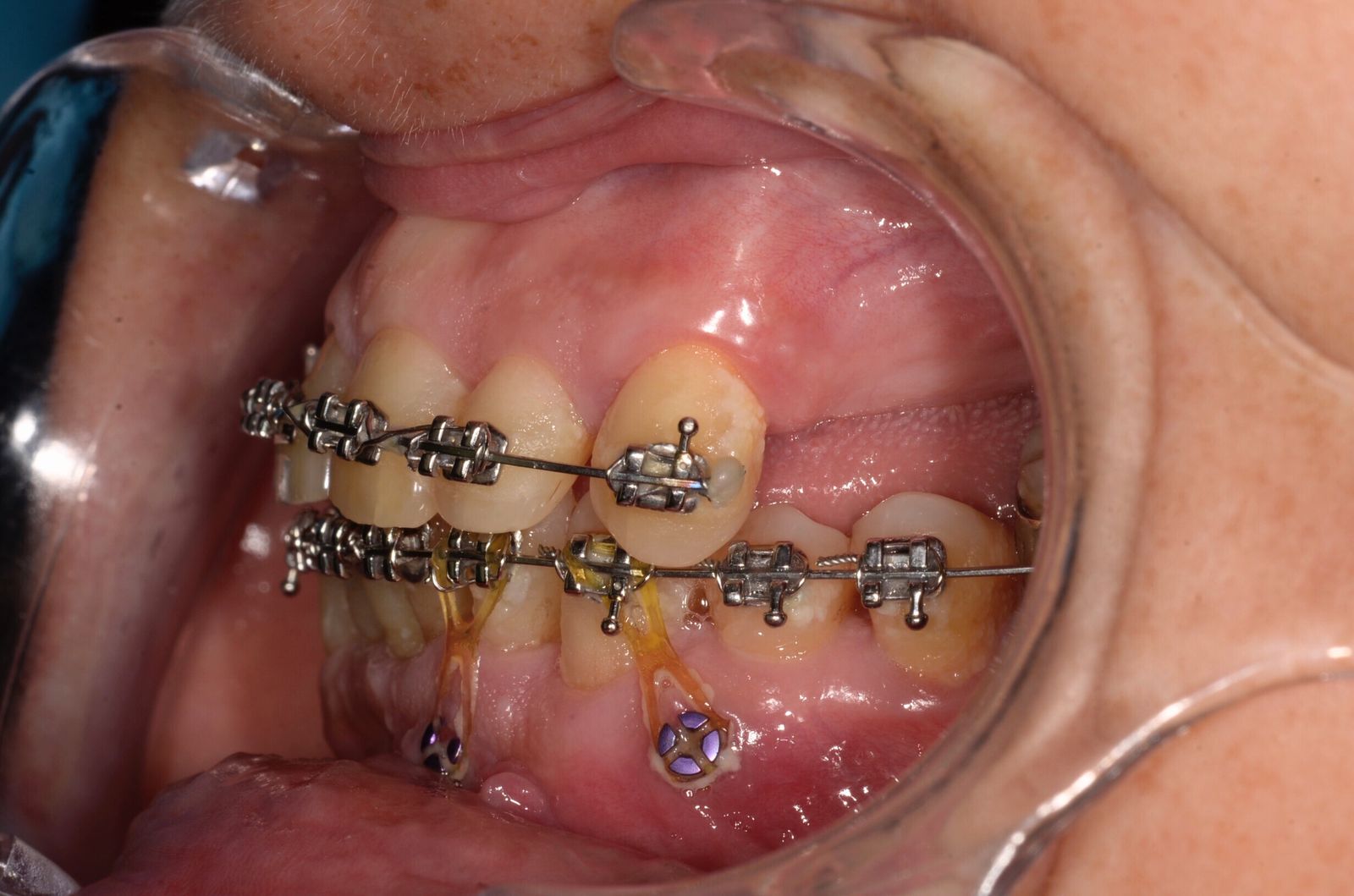 Breketai — atvejis 6