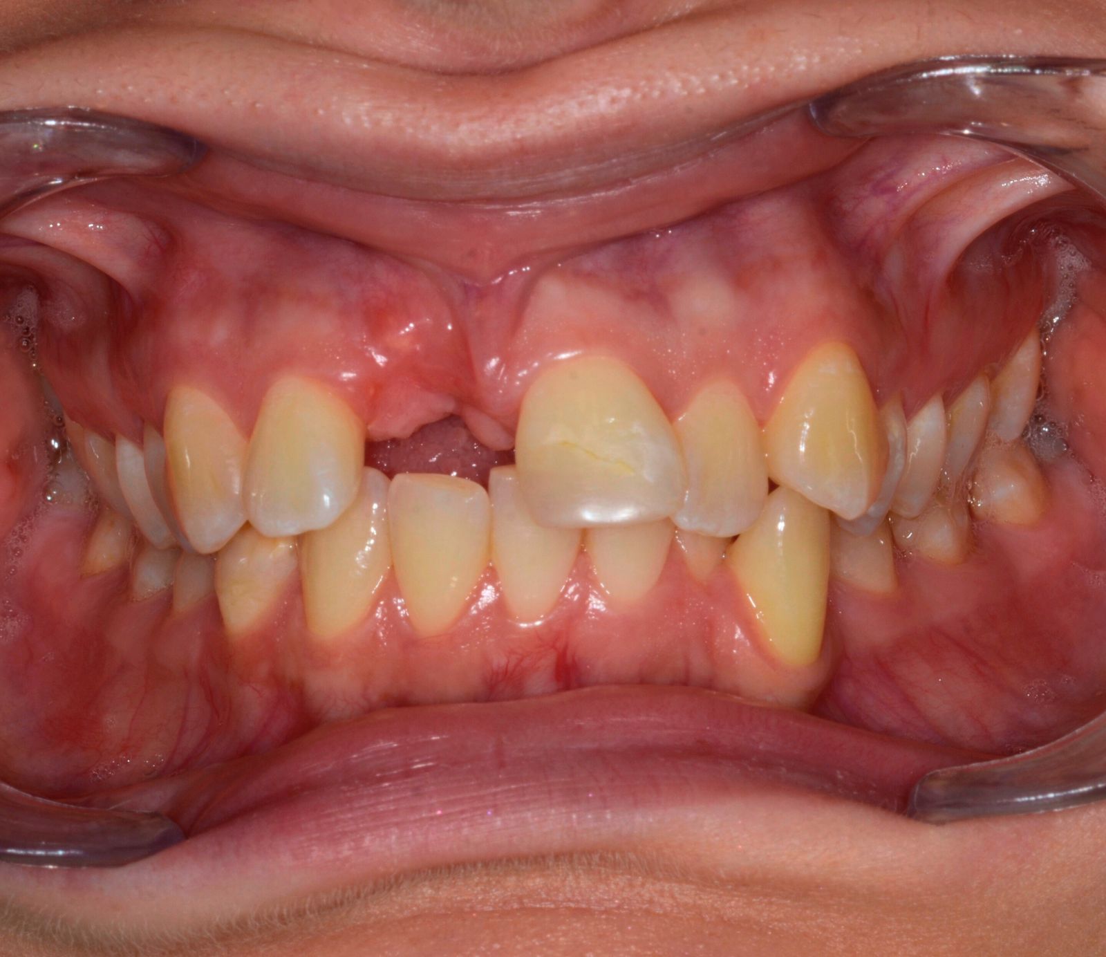 Breketai — atvejis 7