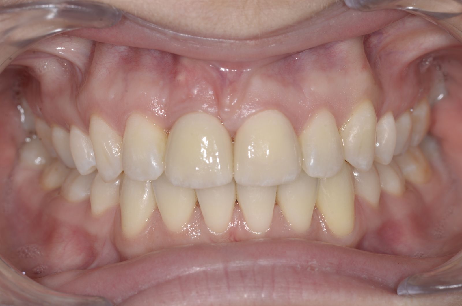 Breketai — atvejis 7