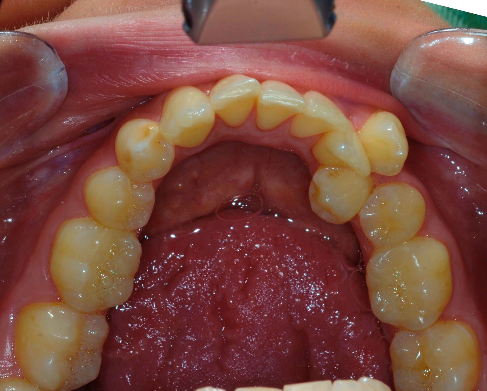 Breketai — atvejis 7