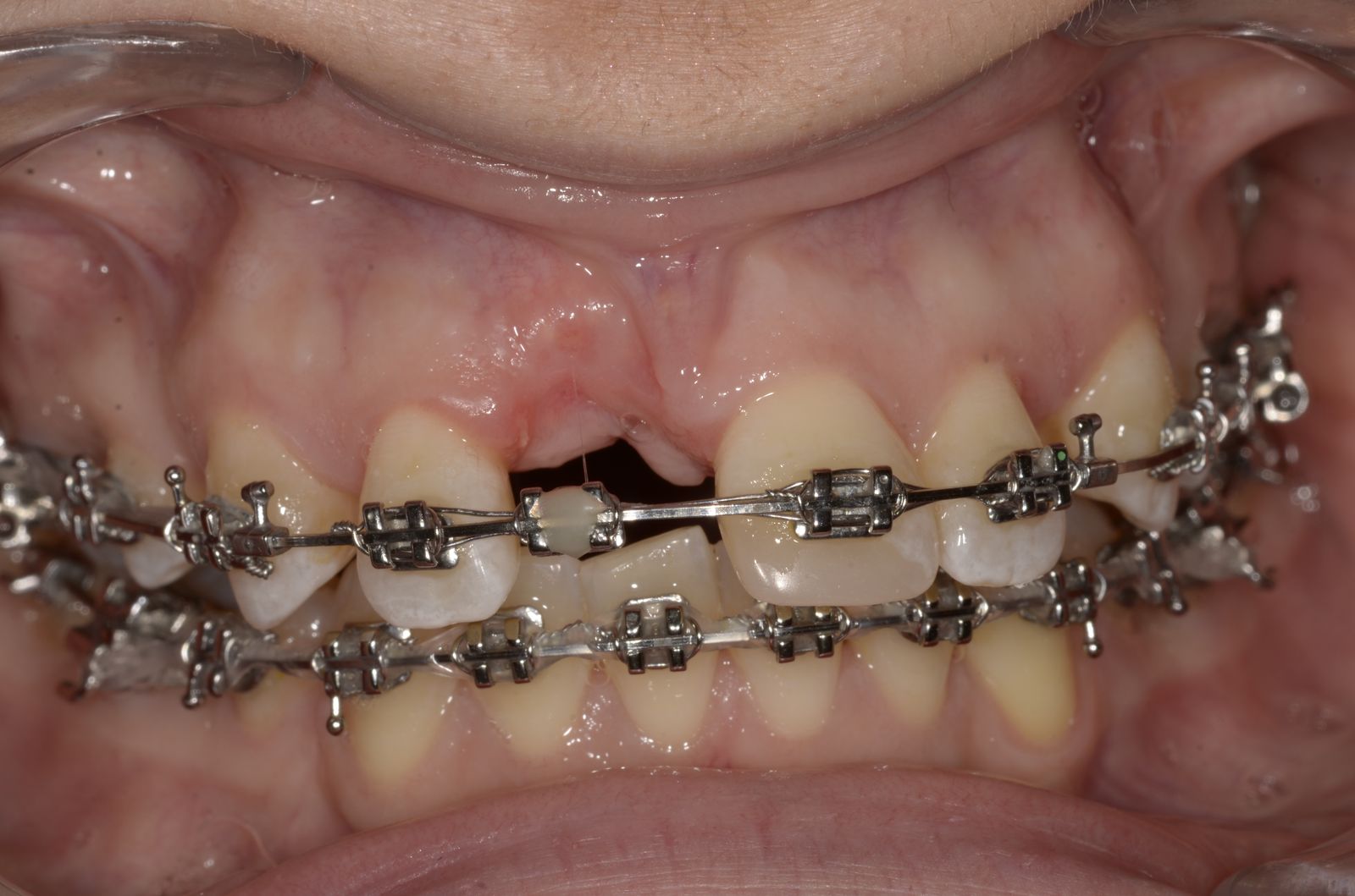 Breketai — atvejis 7