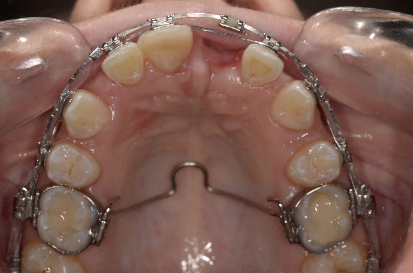 Breketai — atvejis 7