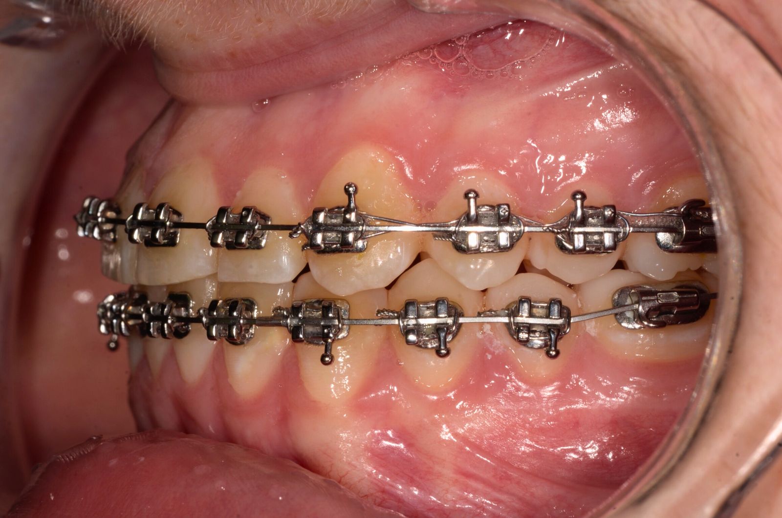 Breketai — atvejis 10