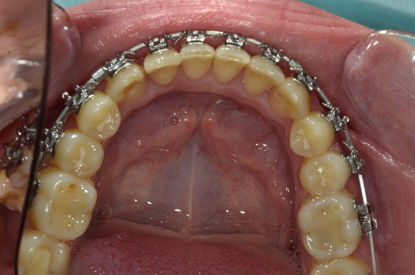 Breketai — atvejis 10