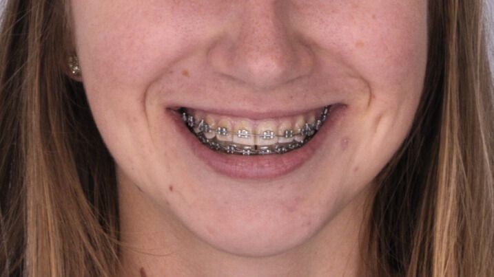 Breketai — atvejis 10