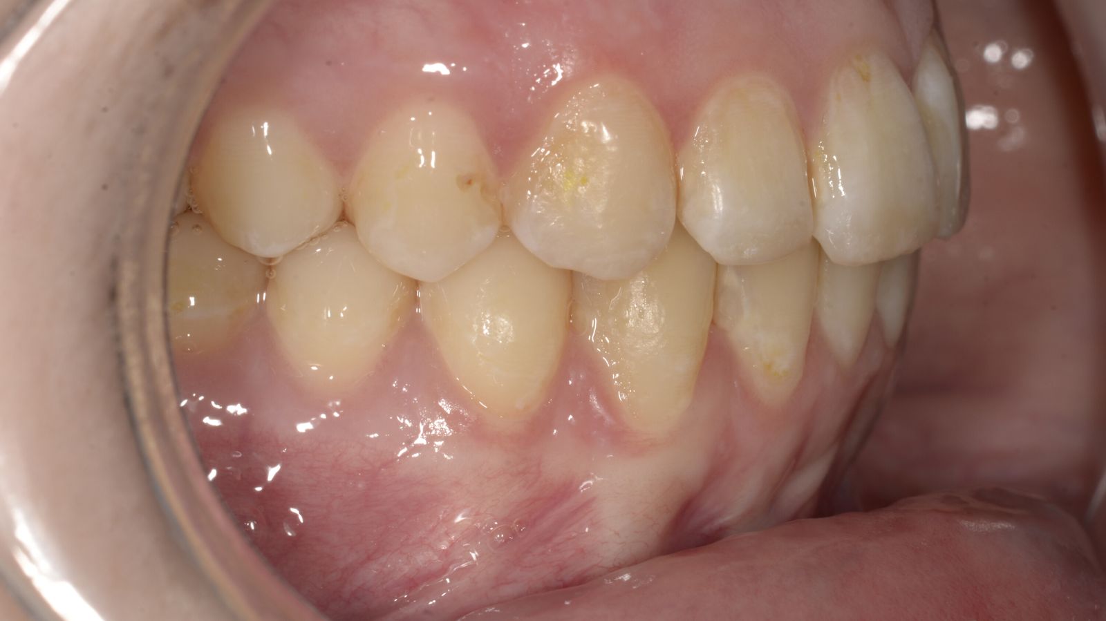 Breketai — atvejis 10