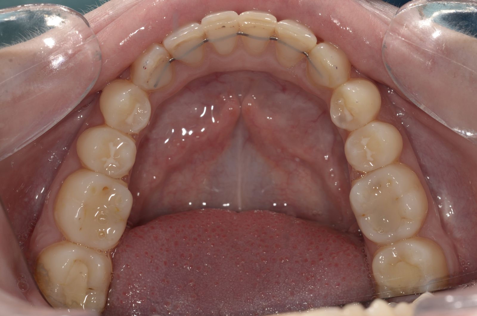 Breketai — atvejis 10