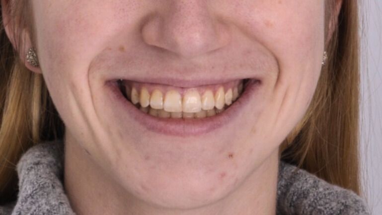 Breketai — atvejis 10