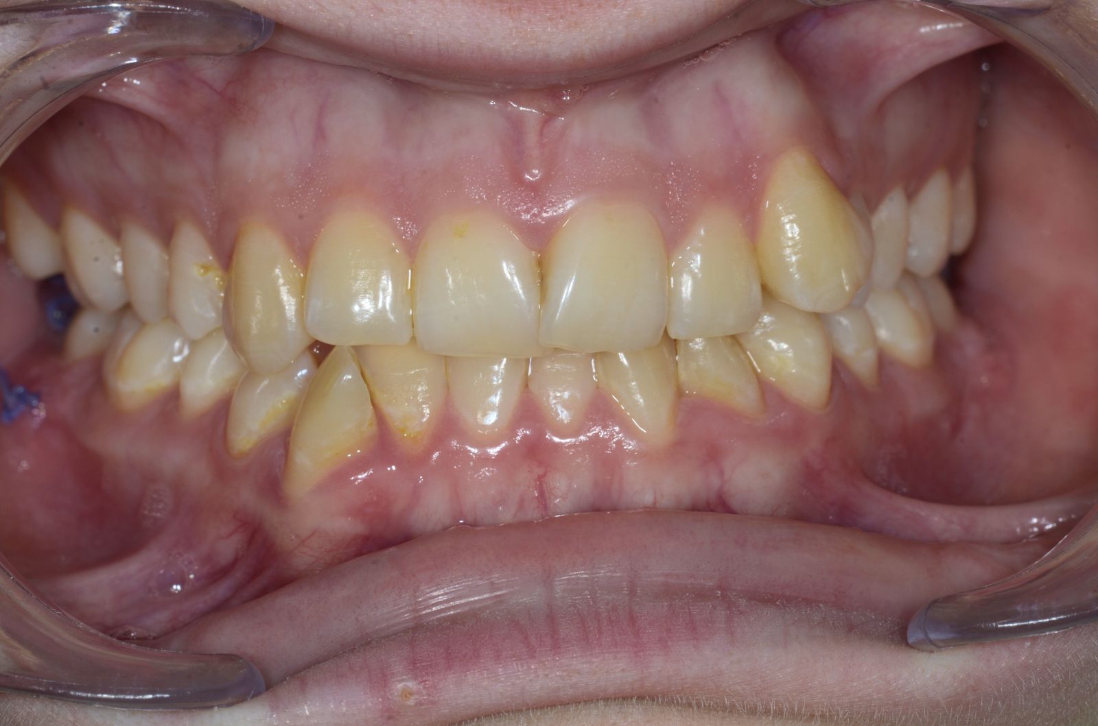 Breketai — atvejis 10