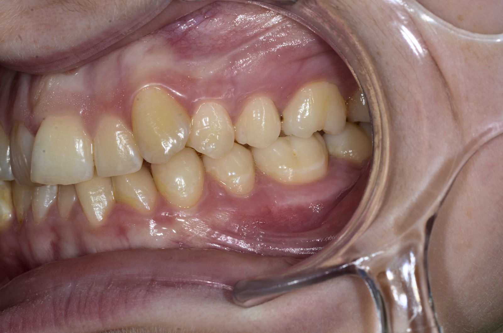 Breketai — atvejis 10