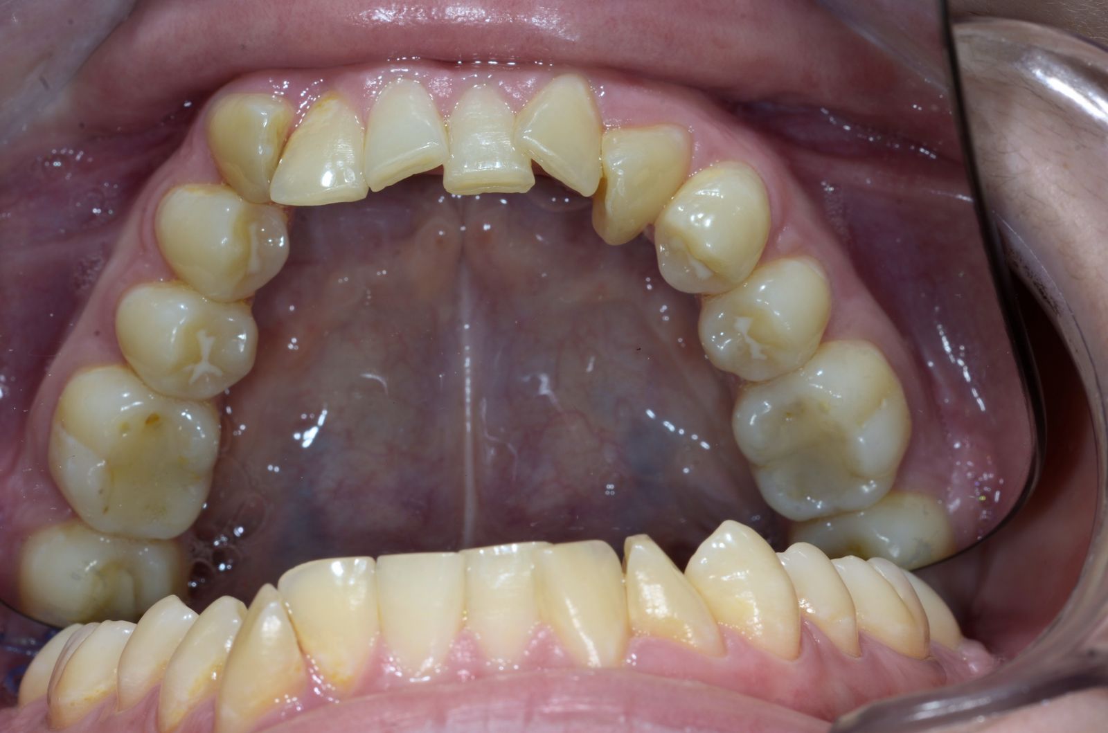 Breketai — atvejis 10