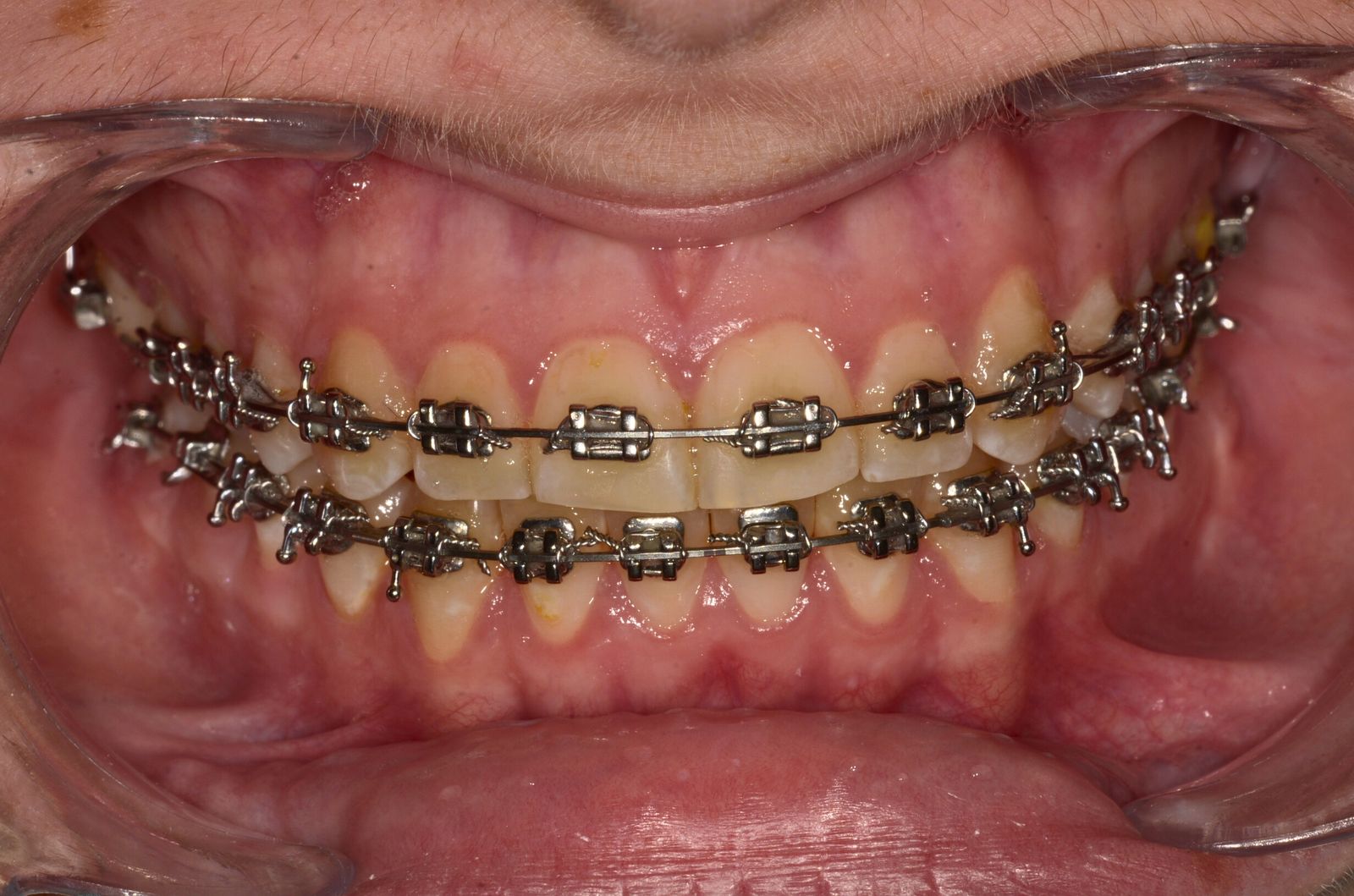 Breketai — atvejis 10