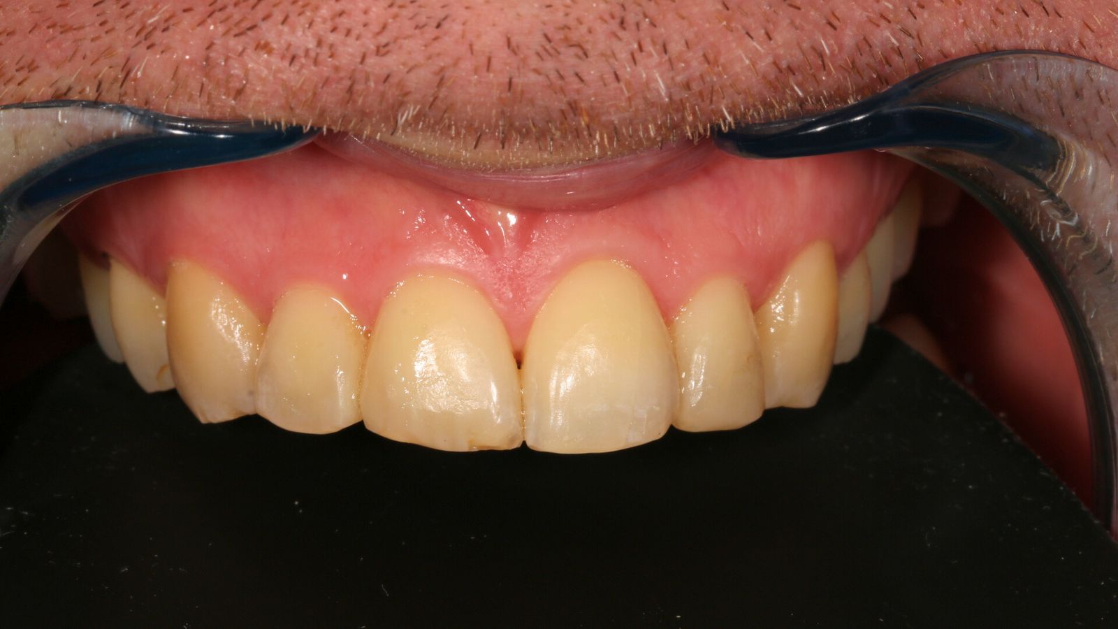 Estetinis plombavimas — atvejis 1